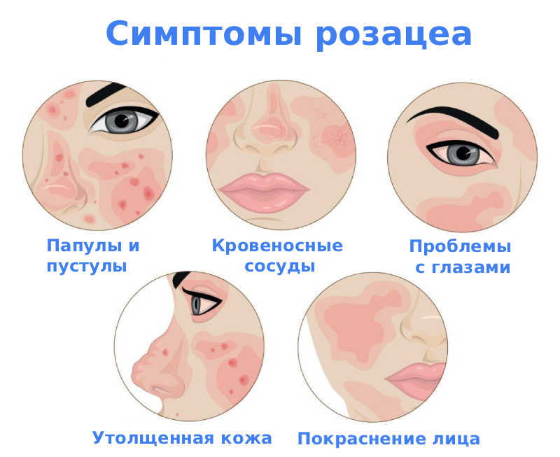 Розацеа на лице