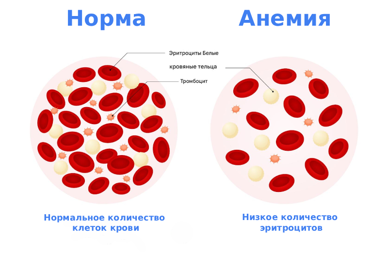 Анемия симптомы