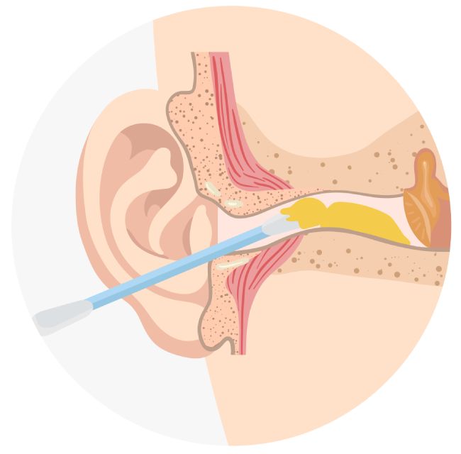 Удаление серной пробки