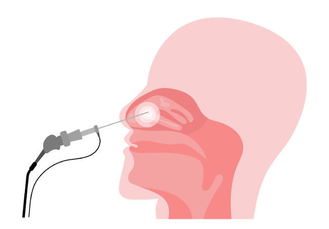 Диагностика кист пазух носа