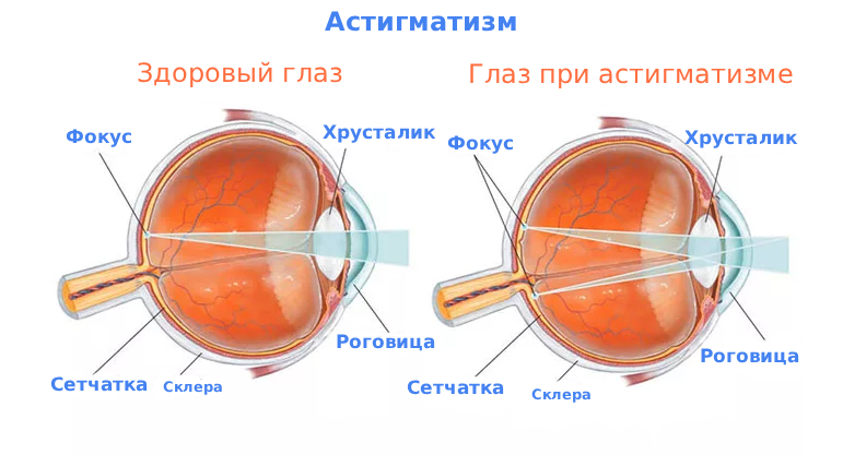 Астигматизм причины и лечение