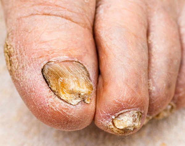 Осложнения грабка ногтей Осложнения грабка ногтей