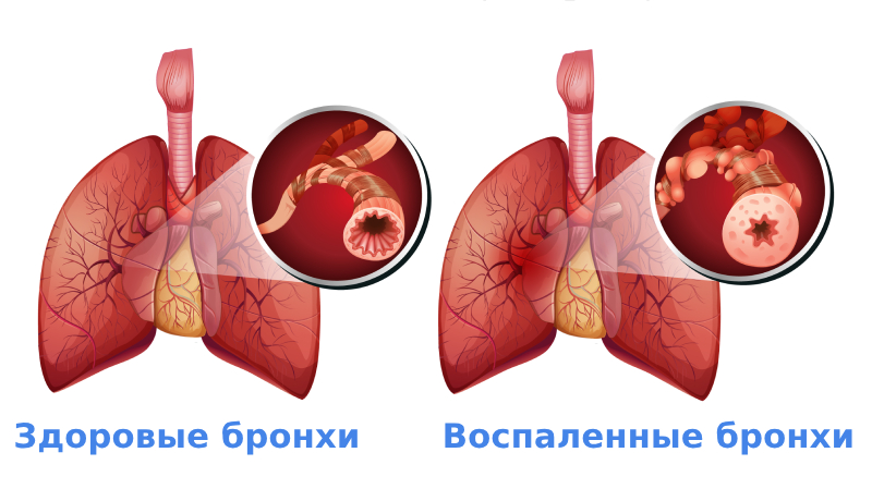 ХОБЛ симптомы и лечение у взрослых