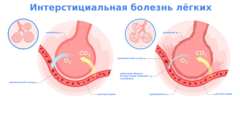 Интерстициальная болезнь легких лечение