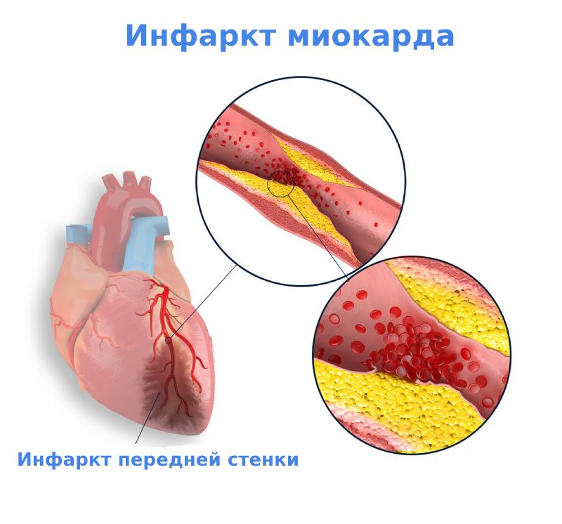 Инфаркт