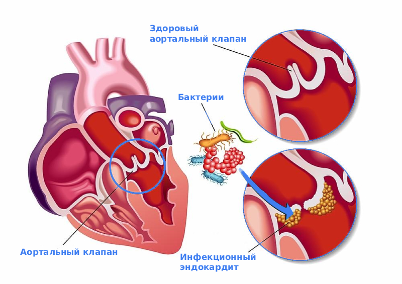 Инфекционный эндокардит симптомы