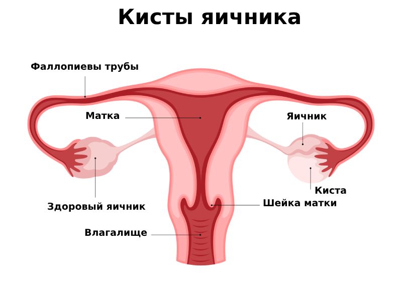 Кисты в яичниках