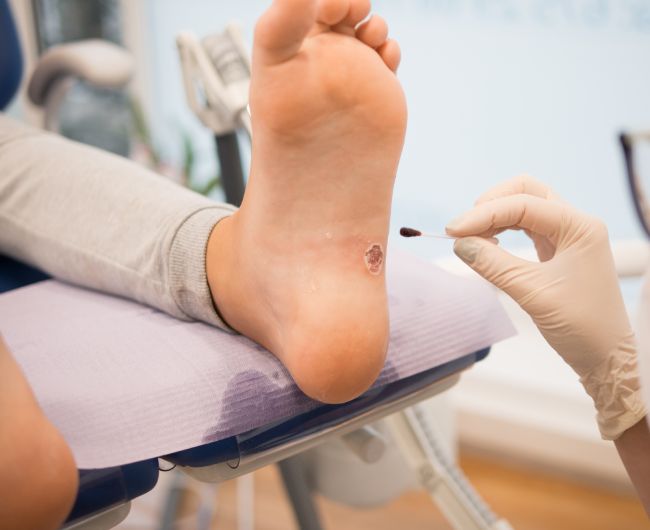 Лечение стержневой мозоли Лечение стержневой мозоли