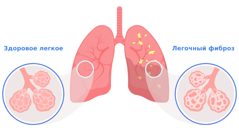 Фиброз легких симптомы и лечение