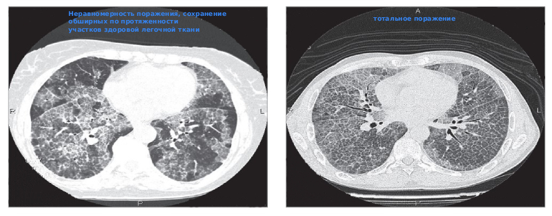 Легочный альвеолярный протеиноз