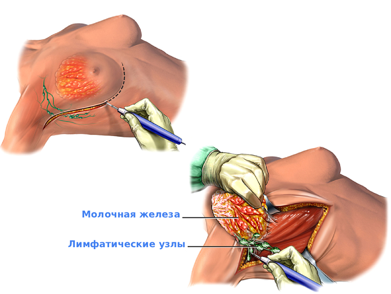 Операция по удалению молочных желез Операция по удалению молочных желез