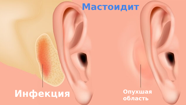 Мастоидит симптомы и лечение
