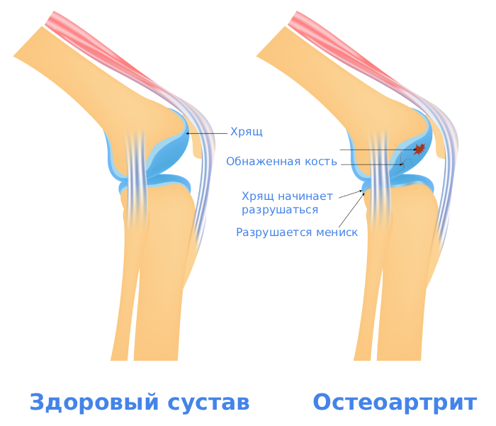 Механизм развития остеоартроза