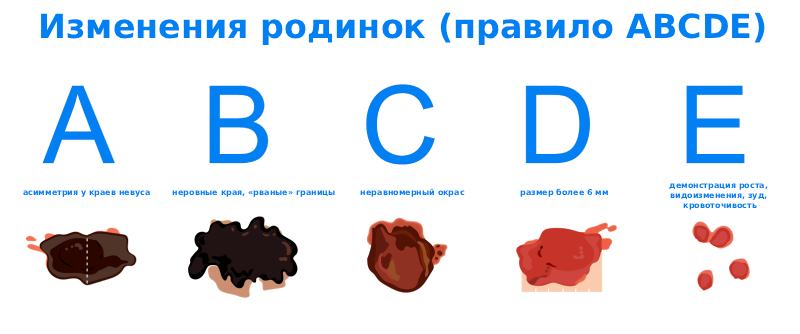 Меланома кожи - симптомы и признаки