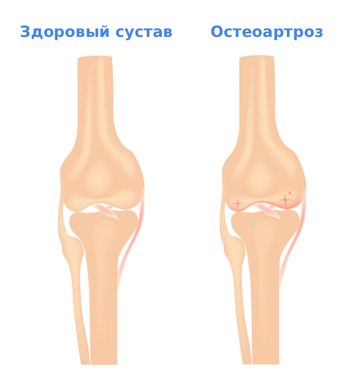 Остеоартроз сустава