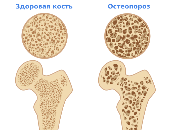 Остеопороз костей