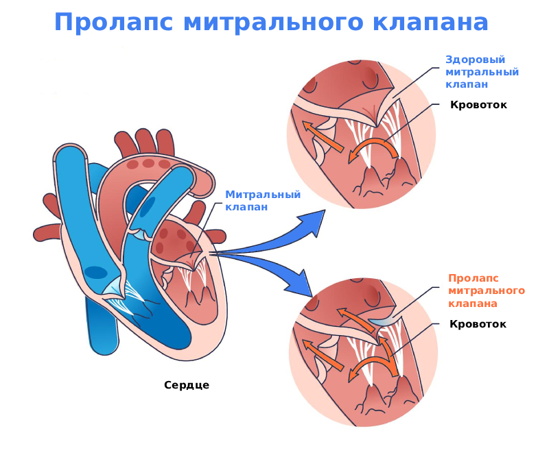 Пролапс митрального клапана сердца