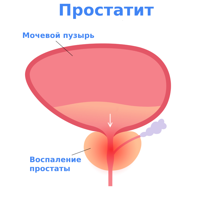 Простатит симптомы и лечение Простатит симптомы и лечение