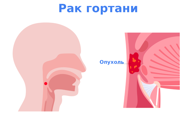 Рак гортани симптомы