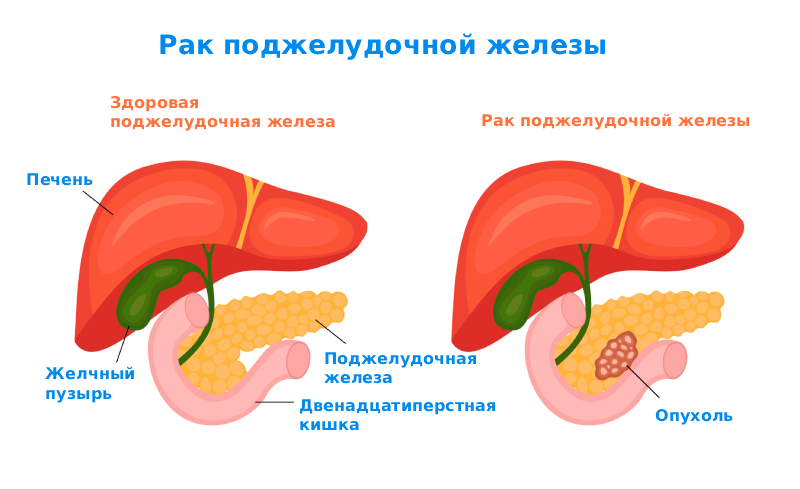 Рак поджелудочной - диагностика и лечение