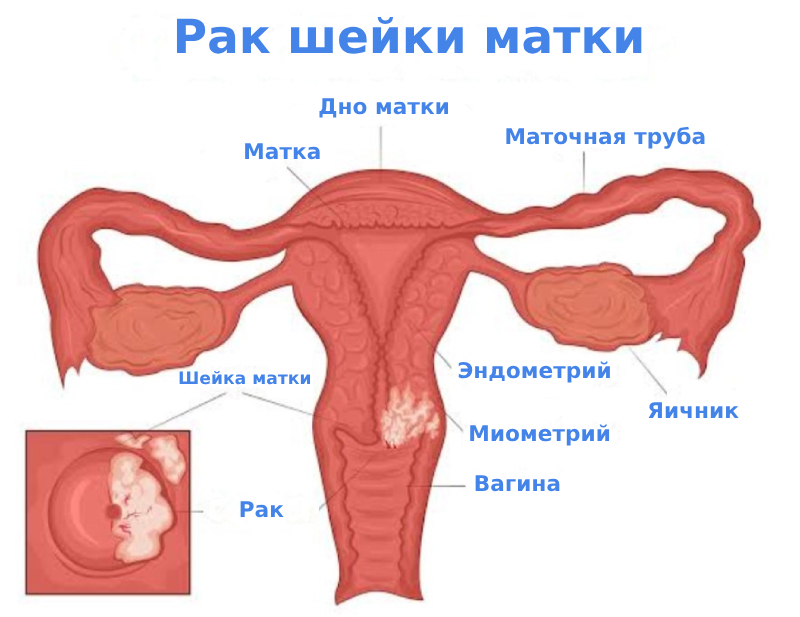 Рак шейки матки - симптомы