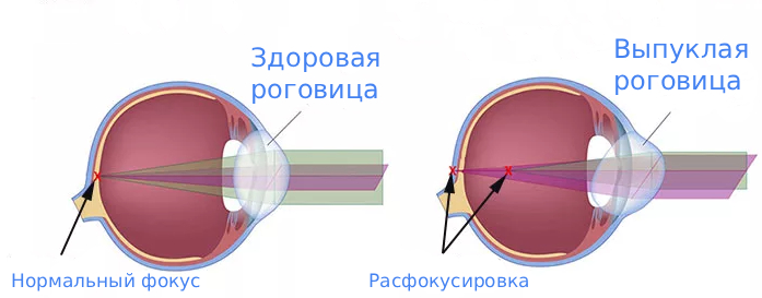 Астигматизм причины развития