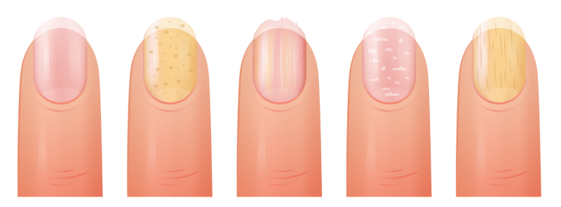 Виды грабка ногтей Виды грабка ногтей