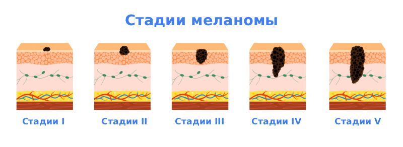 Стадии меланомы