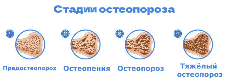 Стадии остеопороза