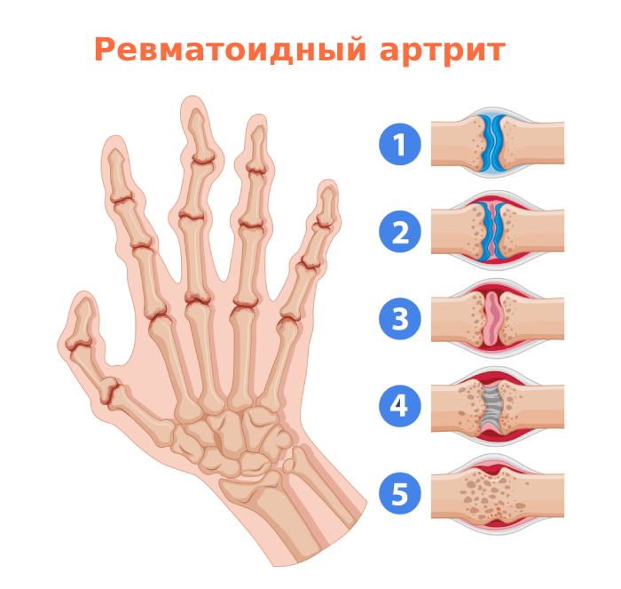 Ревматоидный артрит рук