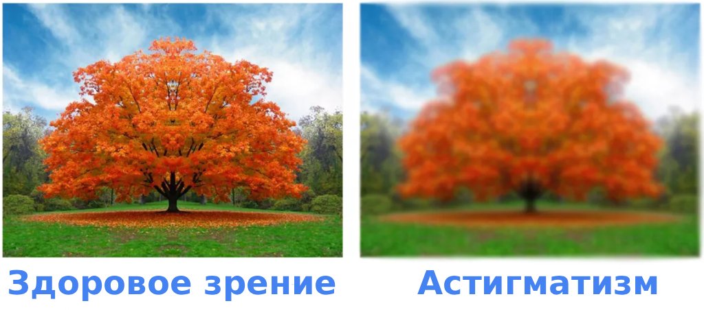 Коррекция астигматизма