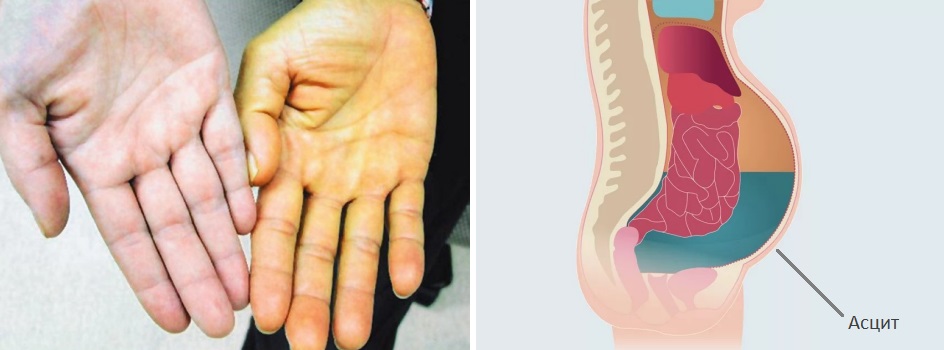 Симптомы рака печени.jpg Симптомы рака печени