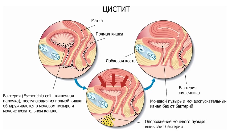 цистит