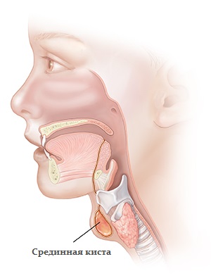срединная киста шеи_1
