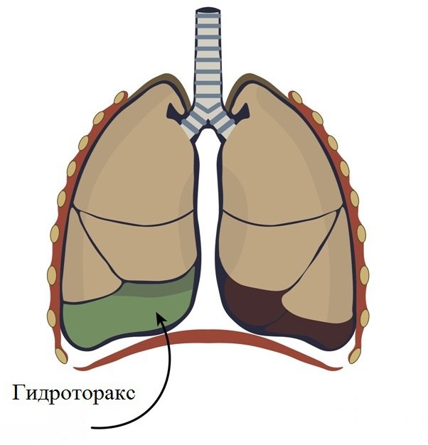 Гидроторакс