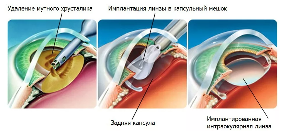 удаление хрусталика