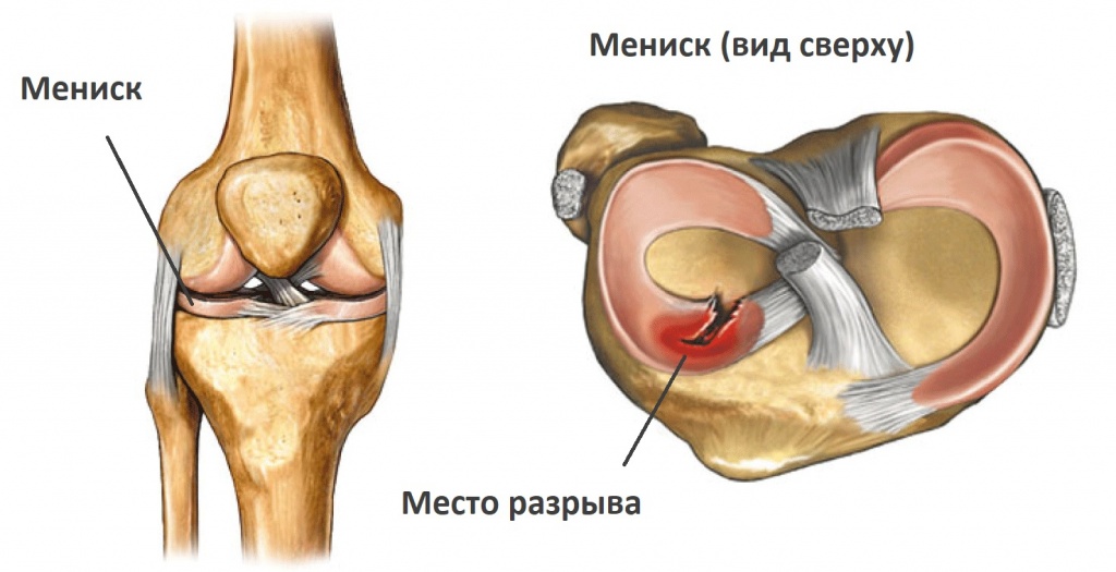 разрыв мениска.jpg