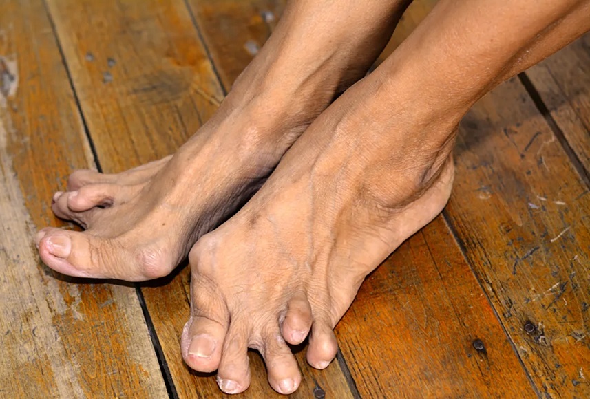 Подагра на ноге