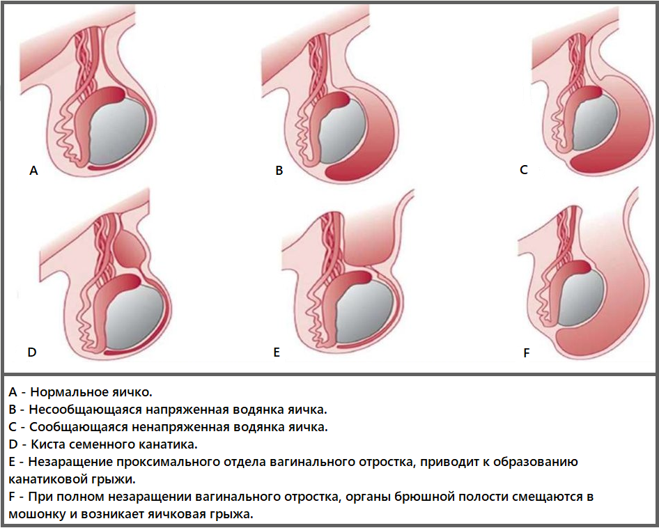 водянка яичка
