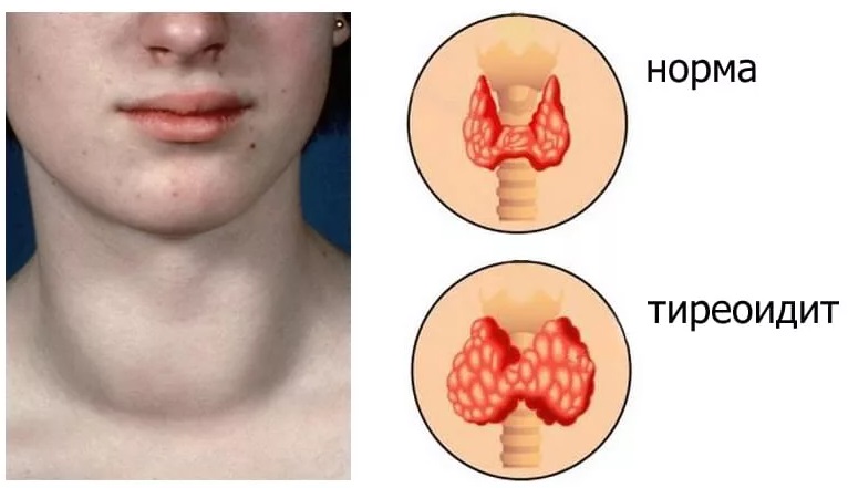 тиреоидит