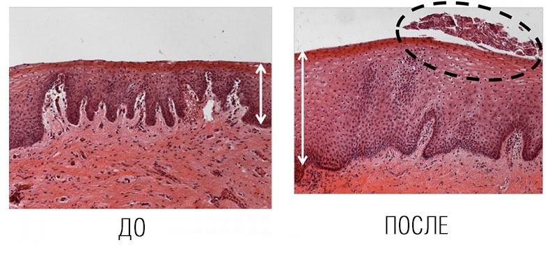 слизистая после лазерного омоложения.jpg