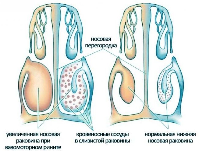вазоматорный ринит