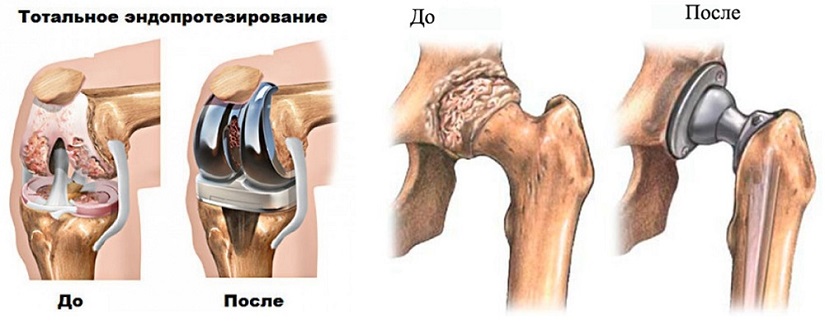 эндопротезирование суставов