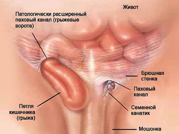 Паховая грыжа лечение