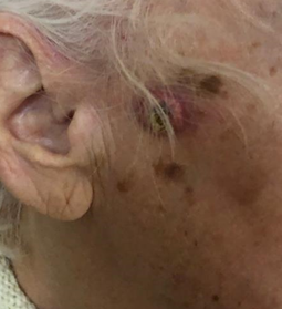 иссечение_1 иссечение_1