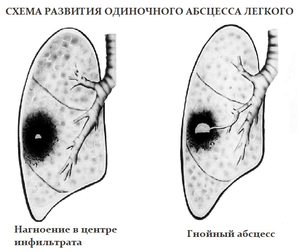 АБСЦЕСС ЛЕГКОГО