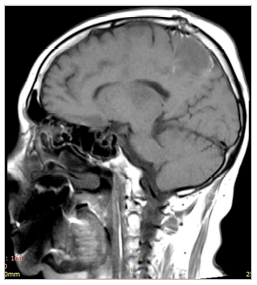 Опухоль головного мозга после лечения
