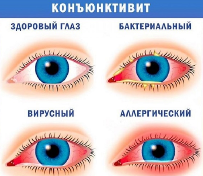 конъюнктивит