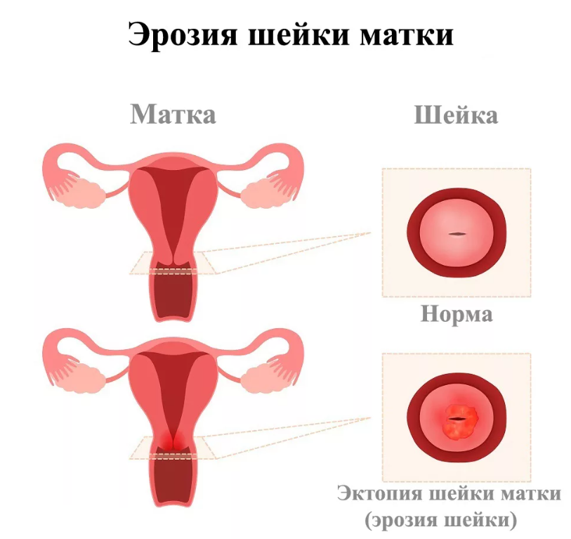 эрозия шейки матки симптомы