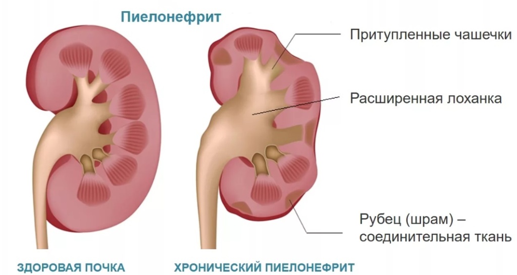 пиелонефрит